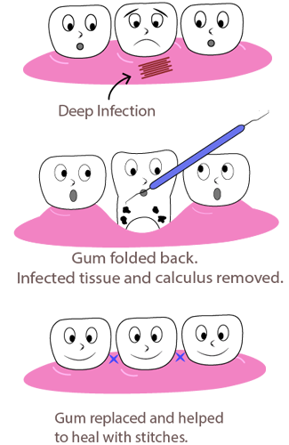02Surgical_Periodontal_Treatment